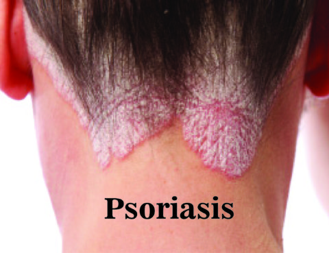 Psoriasis : Symptoms, Causes and Treatment