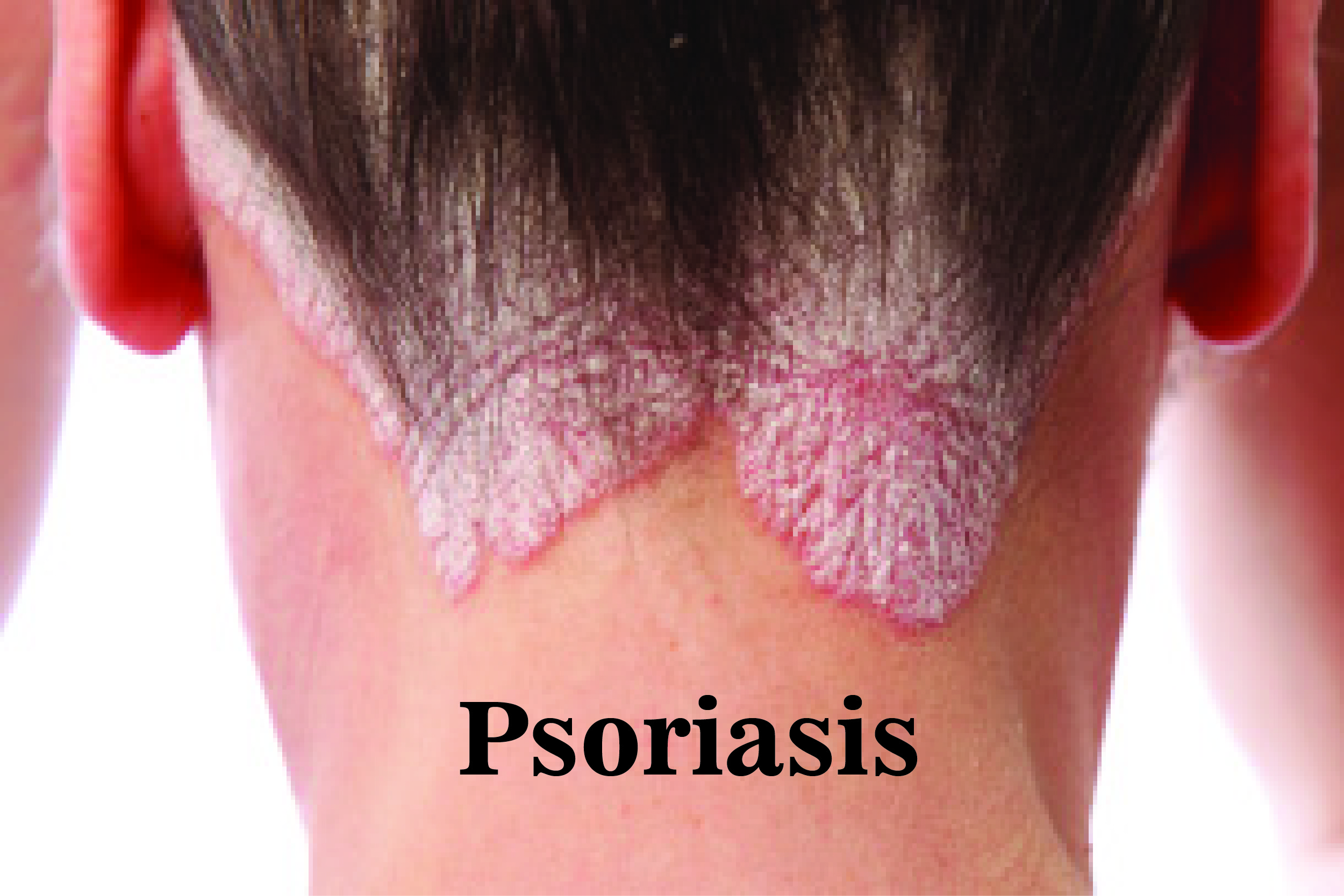 Psoriasis : Symptoms, Causes and Treatment