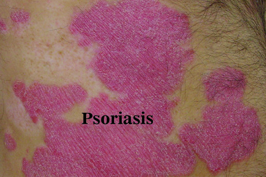 Psoriasis : Symptoms, Causes and Treatment