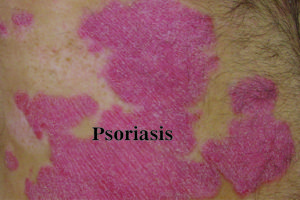 Psoriasis : Symptoms, Causes and Treatment