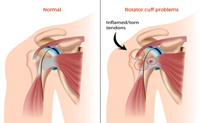 Rotator Cuff Syndrome