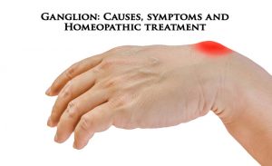 Ganglion: Causes, symptoms and Homeopathic treatment
