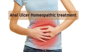 Anal Ulcer: Causes, Symptoms and Homeopathic Treatment