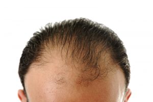 ALOPECIA: Symptoms, Causes and Homeopathy Treatment
