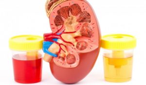 Causes, symptoms, and treatment of Hematuria