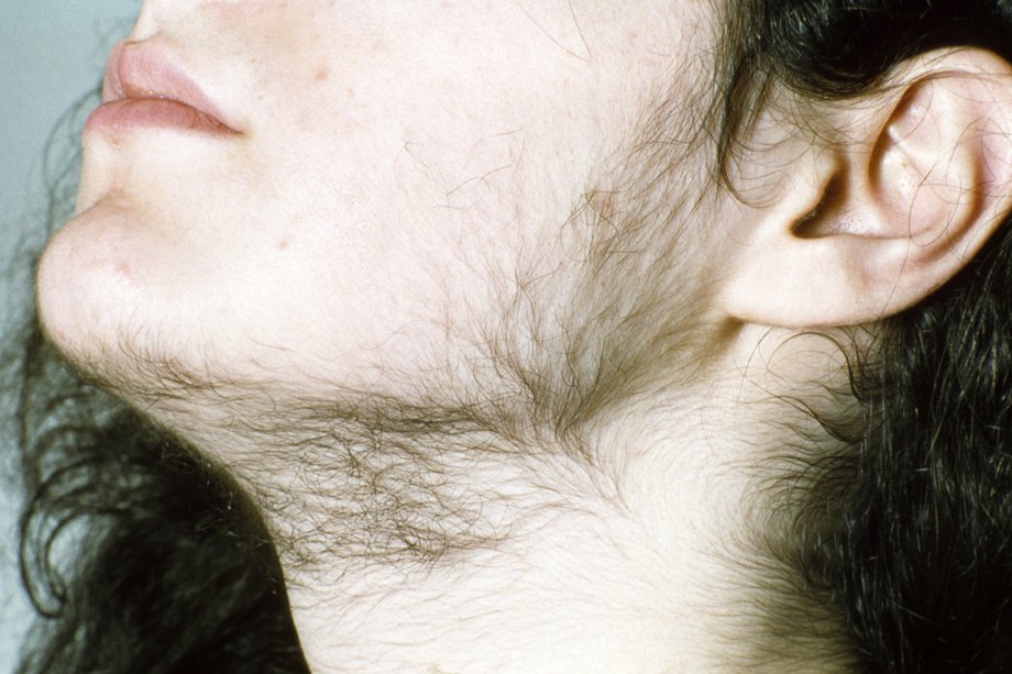 Homeopathy treatments for excessive hairiness in women