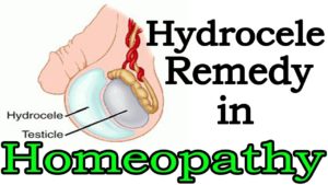 Homeopathic treatment of hydrocele