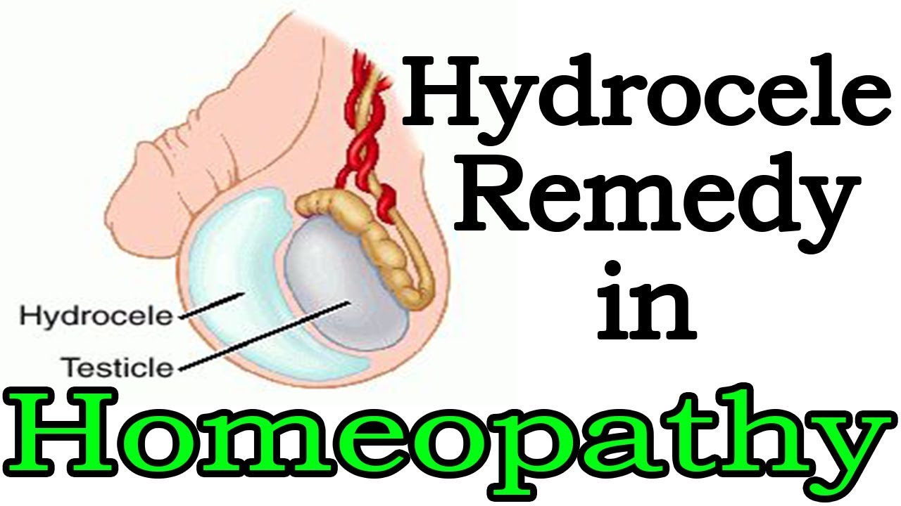 Hydrocele – Symptoms, Causes, Homeopathic Treatment
