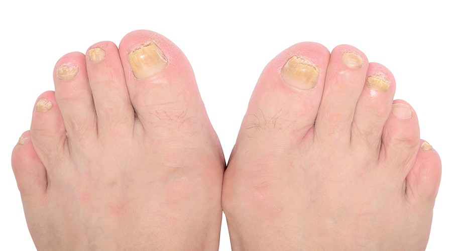 Causes, symptoms and homeopathy treatment of Onychomycosis