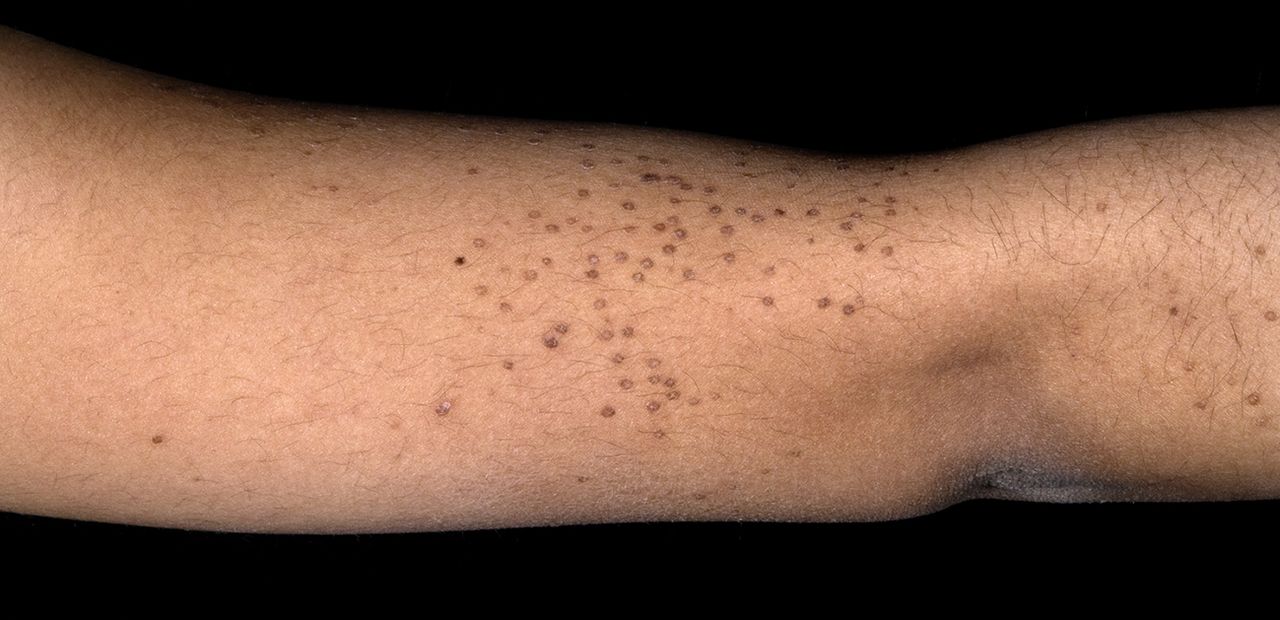 Viral Warts and Its Solution with Homeopathy