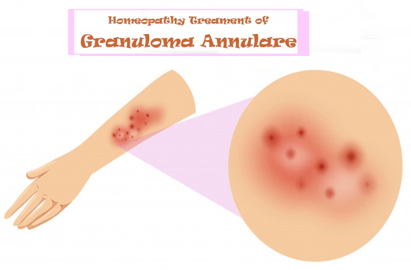 Homeopathy remedies for Granuloma Annulare