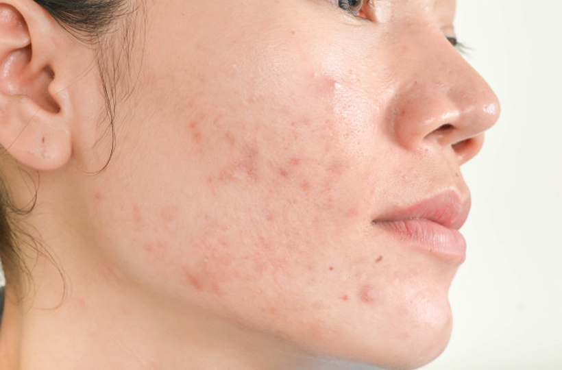 5 Homeopathic Medicines to Treat Unwanted Facial Hair