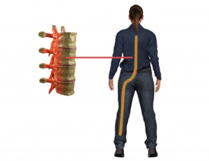 Homeopathy for Sciatica Pain