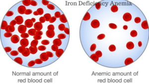 What is iron deficiency anemia – Causes and Symptoms? 