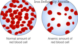 What is iron deficiency anemia – Causes and Symptoms?