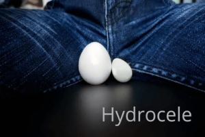 Top 10 Homeopathic Remedies for Hydrocele