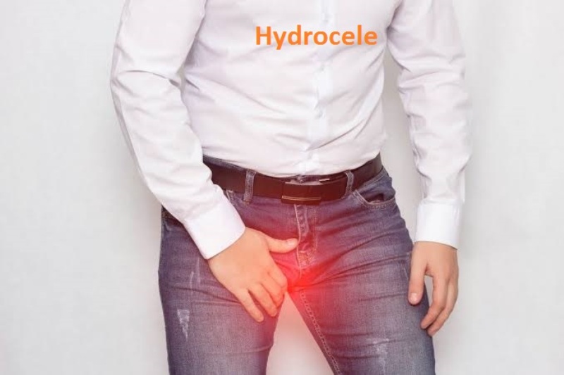 Top 10 Homeopathic Remedies for Hydrocele