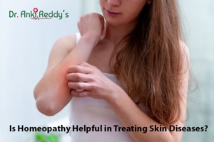 Is Homeopathy Helpful in Treating Skin Diseases?