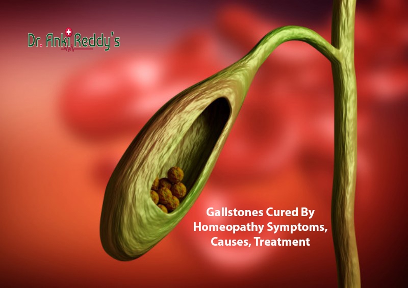 Gallstones Cured By Homeopathy Symptoms, Causes, Treatment