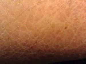 Scale-down Ichthyosis suffering with Homeopathy