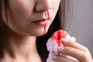 5 Effective Home Remedies to Stop Nose Bleeding