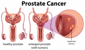 What is Prostate Cancer?