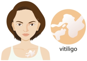 5 Best Homeopathic medicine for Vitiligo 