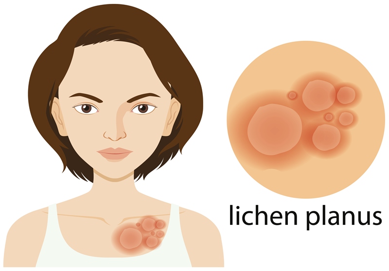 Is cure of Lichen Planus possible with Homeopathy?
