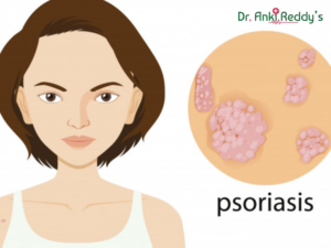Psoriasis Treatment, Causes, Symptoms, Types
