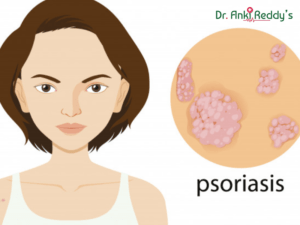 Psoriasis Treatment, Causes, Symptoms, Types 