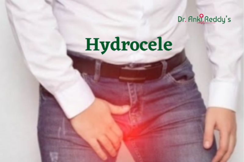 10 Home Remedies for Hydrocele