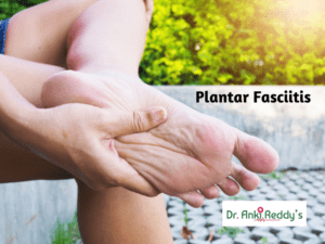 Best Treatment for Plantar Fasciitis Often known as Heel Pain