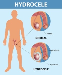 10 Home Remedies for Hydrocele