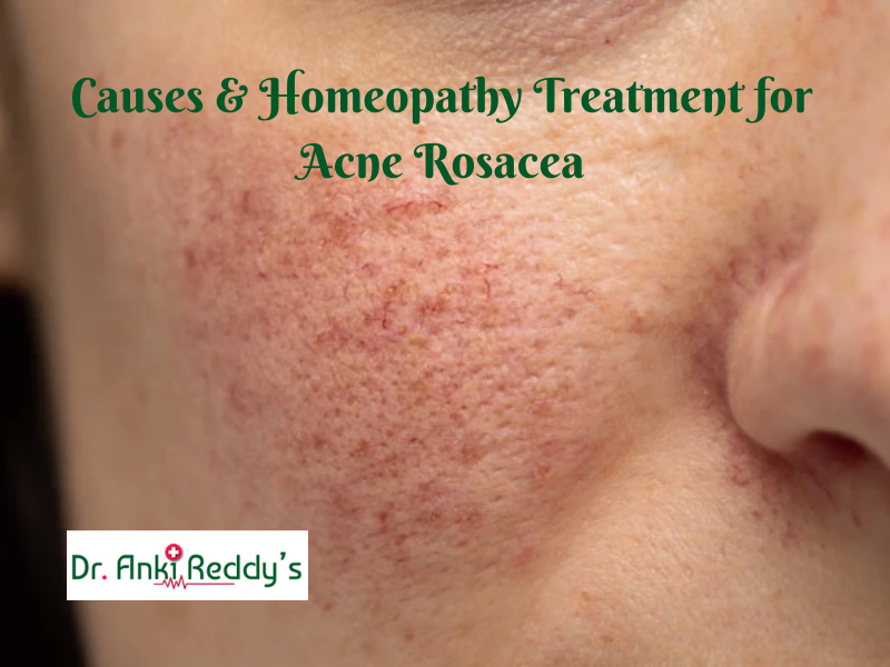 Causes & Homeopathy Treatment for Acne Rosacea