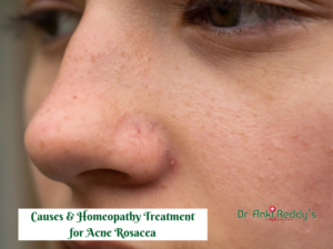 Causes & Homeopathy Treatment for Acne Rosacea