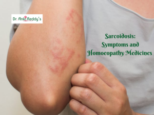 Sarcoidosis: Symptoms and Homoeopathy Medicines
