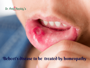 Behcet's disease to be treated by homeopathy