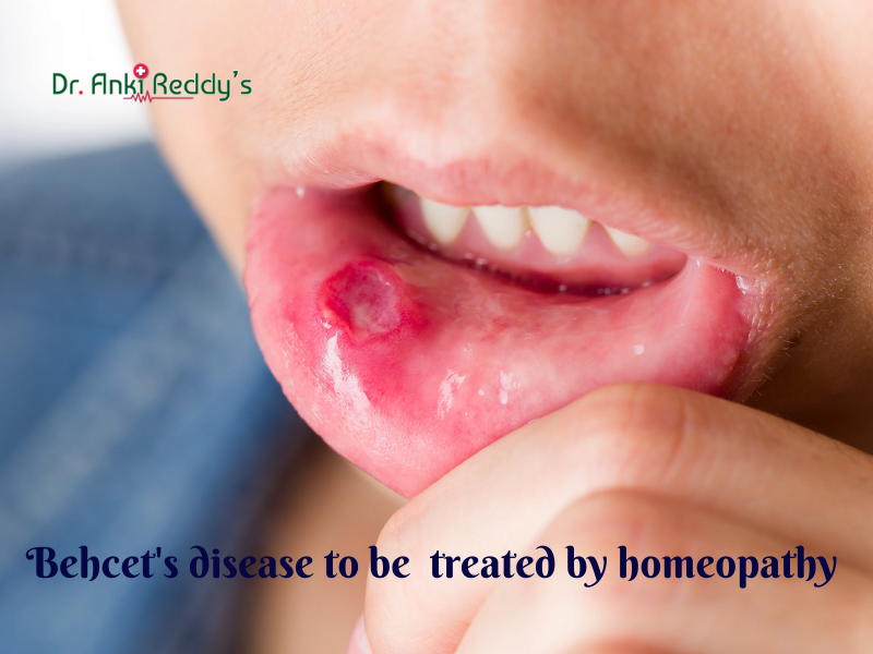 Behcet’s disease to be  treated by homeopathy