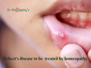 Behcet's disease to be treated by homeopathy