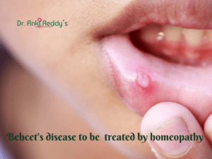 Behcet's disease to be treated by homeopathy 