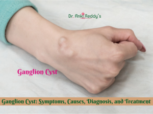 Ganglion Cyst: Symptoms, Causes, Diagnosis, and Treatment