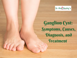 Ganglion Cyst: Symptoms, Causes, Diagnosis, and Treatment 