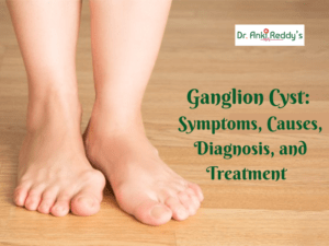 Ganglion Cyst: Symptoms, Causes, Diagnosis, and Treatment