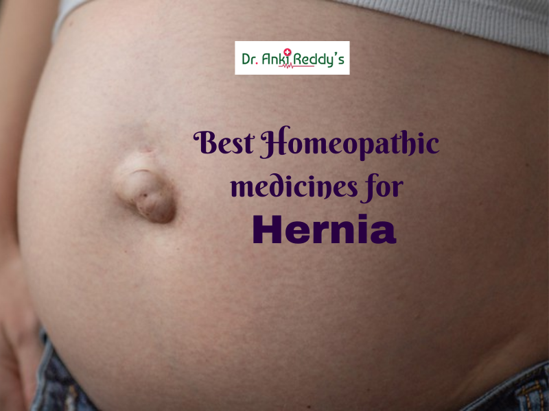 Best Homeopathic medicines for Hernia