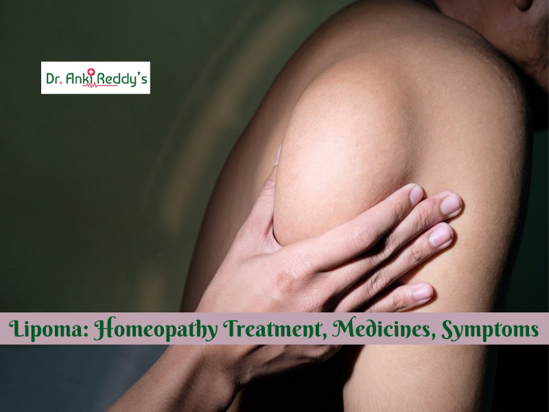 Lipoma: Homeopathy Treatment, Medicines, Symptoms