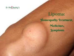 Lipoma: Homeopathy Treatment, Medicines, Symptoms
