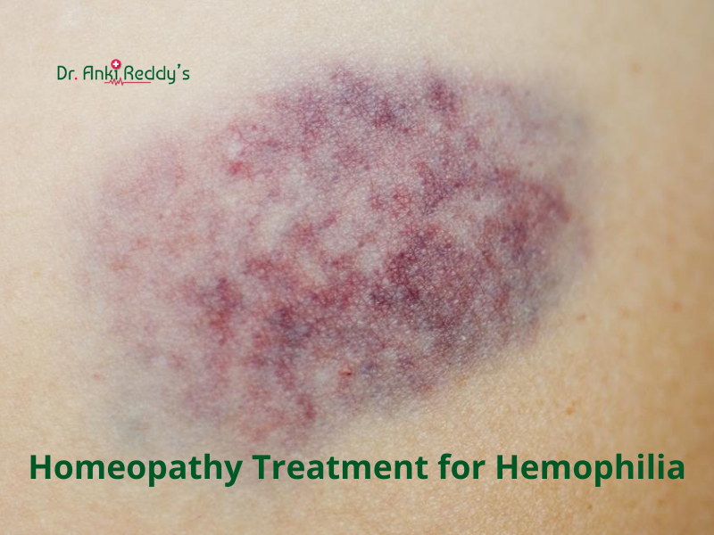 Homeopathy Treatment for Hemophilia