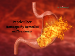 Peptic ulcer Homeopathy Remedies and Treatment