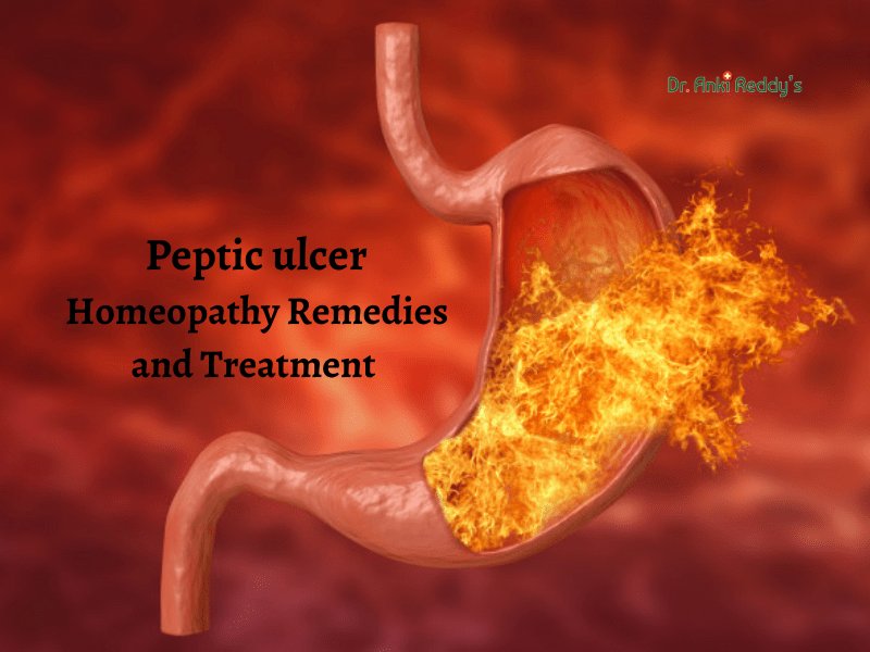 Peptic ulcer Homeopathy Remedies and Treatment