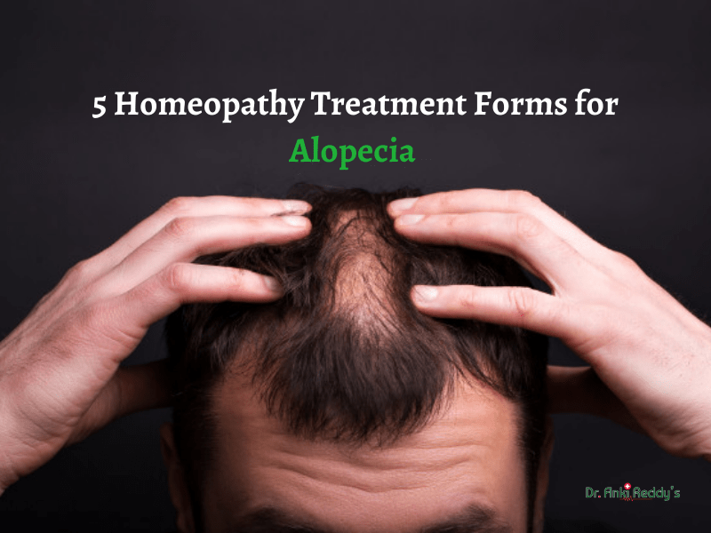 5 Homeopathy Treatment Forms for Alopecia